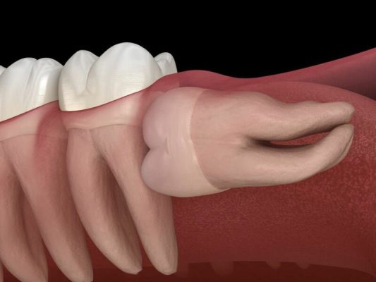 Nhổ răng khôn có gây biến chứng nguy hiểm gì không?
