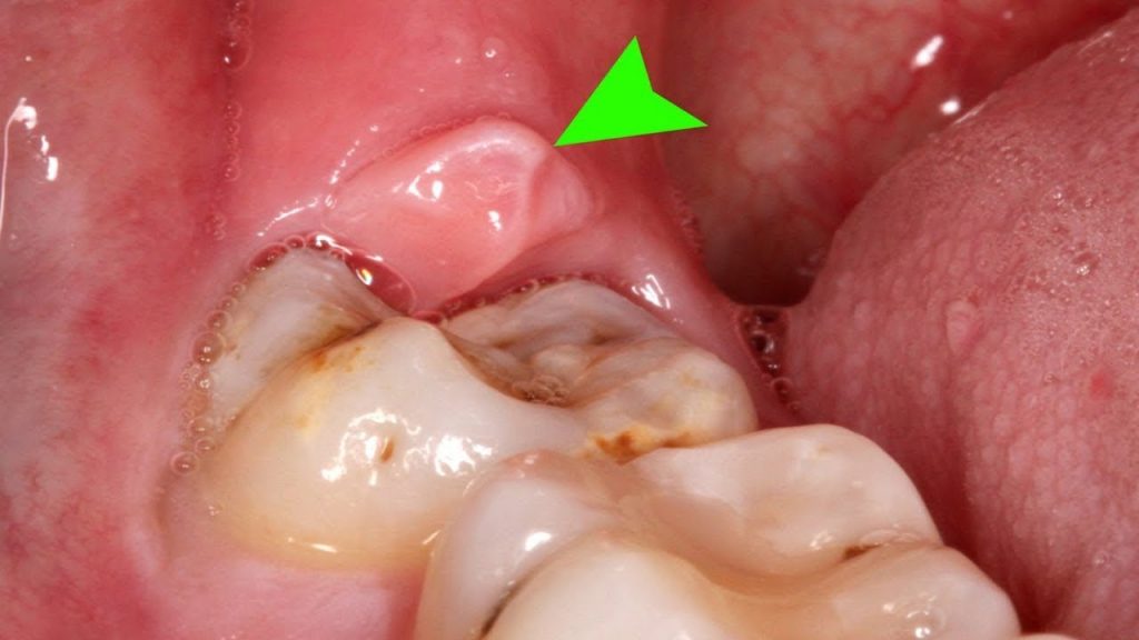 Chăm sóc răng miệng sau khi nhổ răng khôn như thế nào