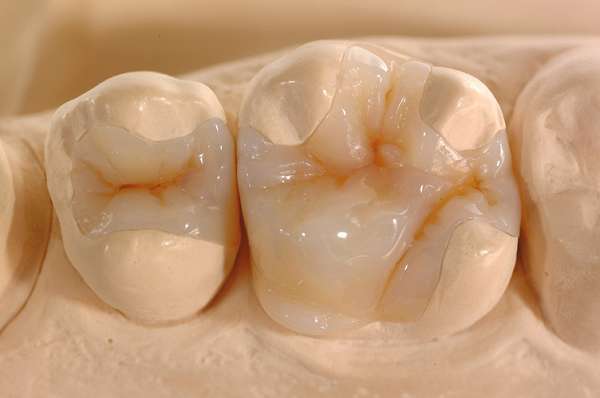 Hàn răng sứ inlay onlay Thái Bình đem lại nhiều lợi ích