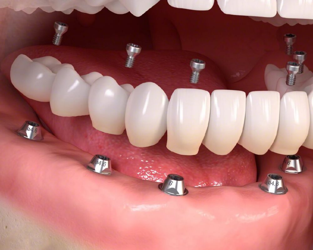 Trồng răng implant tại Thái Bình là giải pháp phục hình tân tiến nhất hiện nay