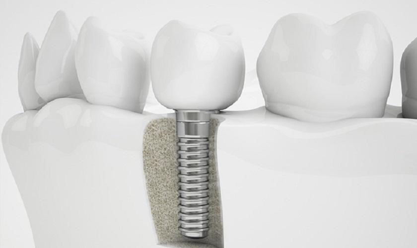 Ưu điểm trồng răng implant Thái Bình và cách chăm sóc