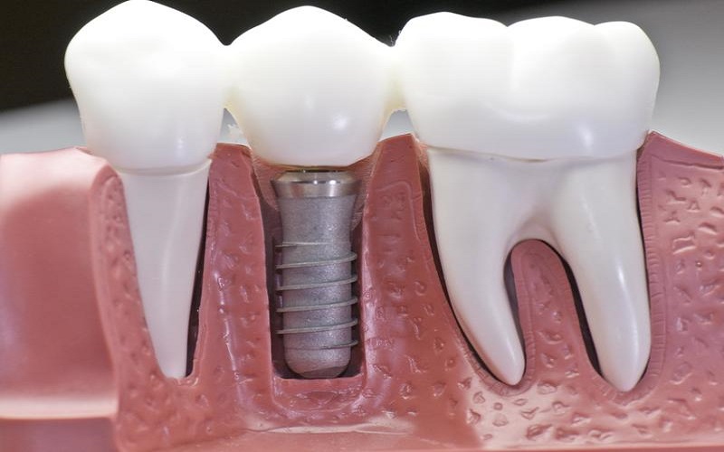 Những lưu ý khi trồng răng Implant Thái Bình