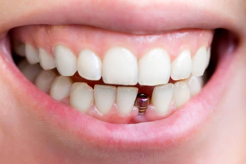 Ưu điểm nổi bật của trồng răng implant Thái Bình được nhiều người quan tâm