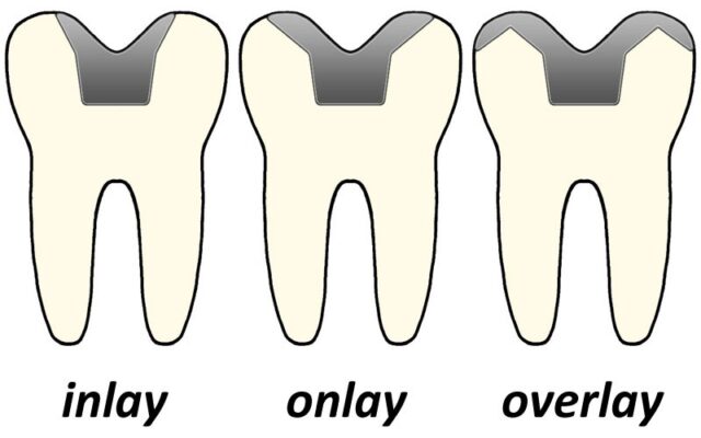 Hàn răng sứ inlay onlay Thái Bình giải pháp mới cho trường hợp răng sâu