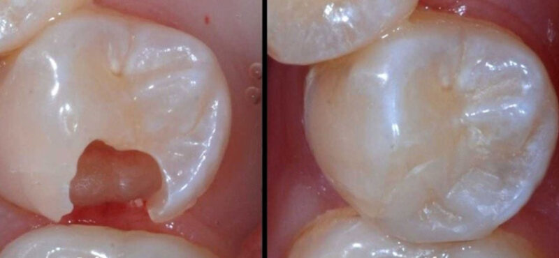 Hàn răng sứ inlay onlay ở Thái Bình sử dụng chất liệu sứ để phục hình răng