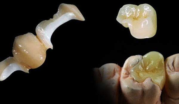 Hàn răng sứ inlay onlay Thái Bình giải pháp mới cho trường hợp răng sâu