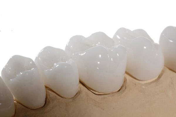 Tìm hiểu sự khác biệt của phương pháp hàn răng sứ inlay onlay Tp Thái Bình
