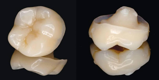 Hàn răng sứ inlay onlay tại Thái Bình phục hồi cấu trúc răng 