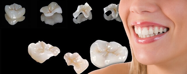 Hàn răng sứ inlay onlay Thái Bình giúp những chiếc răng sâu có hình thể đẹp hơn