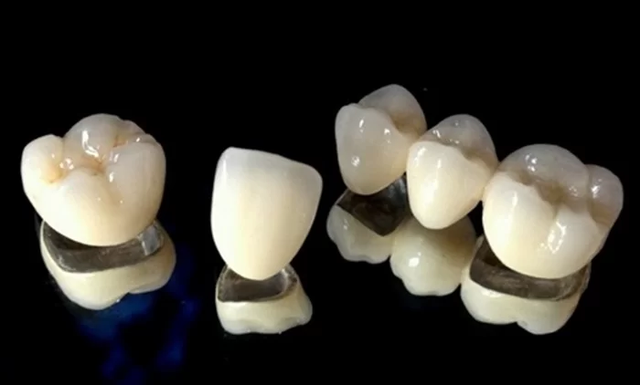 Hàn răng sứ inlay onlay Thái Bình hạn chế tình trạng sâu răng
