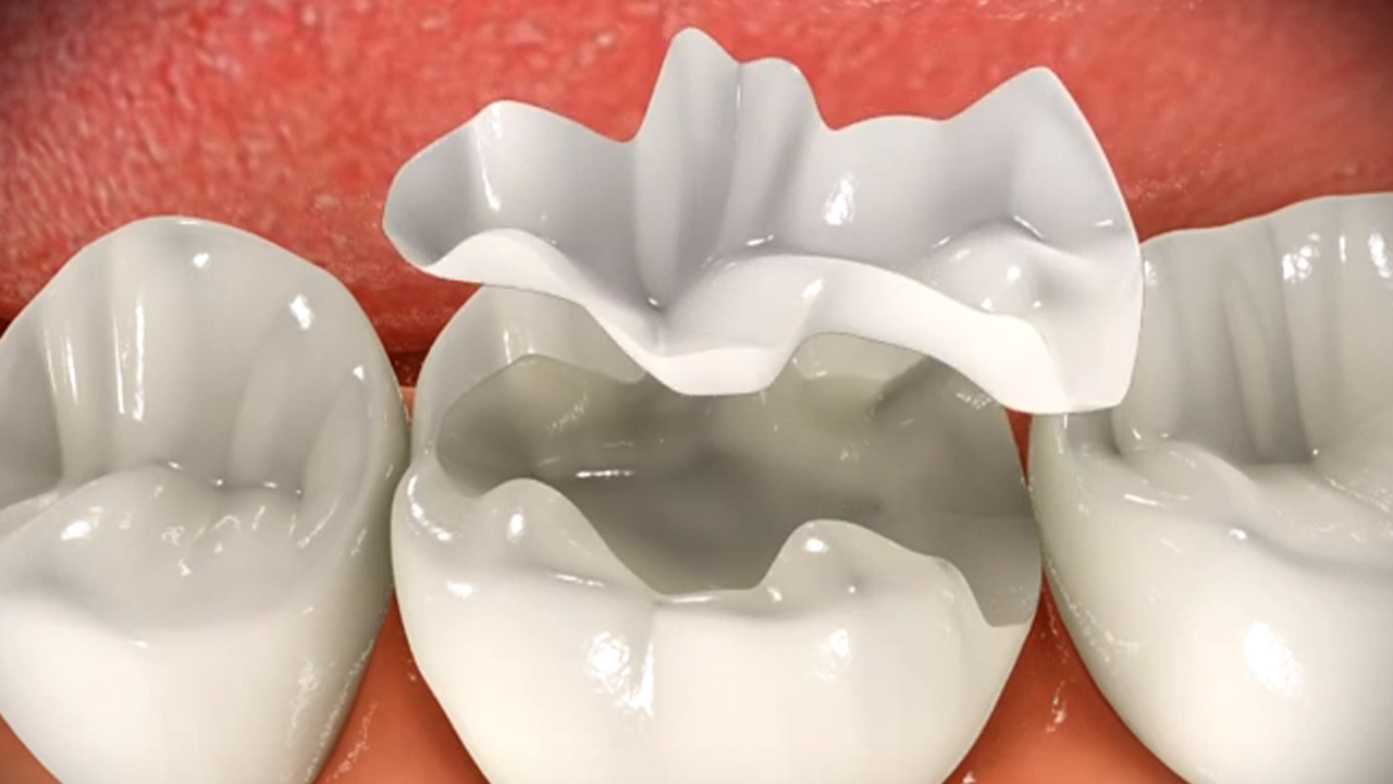 Hàn răng sứ inlay onlay ở Thái Bình bảo vệ cấu trúc răng hoàn hảo: