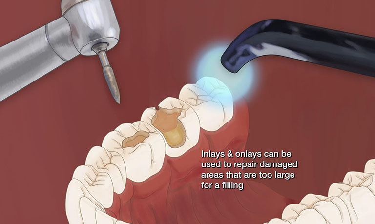 Quy trình hàn răng sứ inlay onlay Tp Thái Bình diễn ra như thế nào?