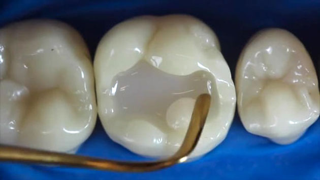 Hàn răng sứ inlay onlay ở Thái Bình sử dụng chất liệu sứ để phục hình răng