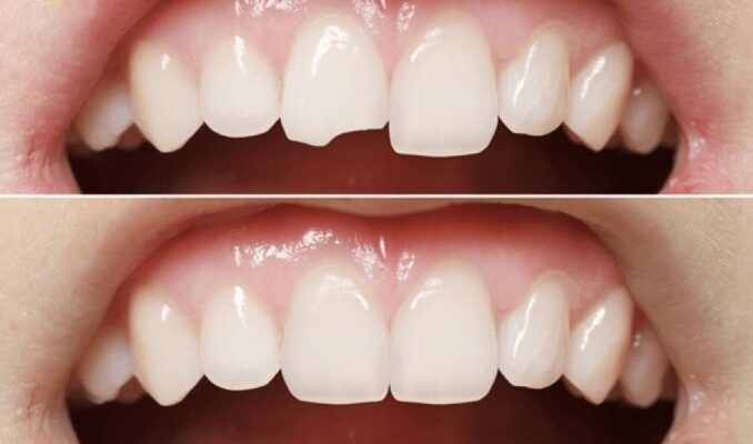 Những ưu điểm của kỹ thuật hàn răng sứ inlay onlay Thái Bình
