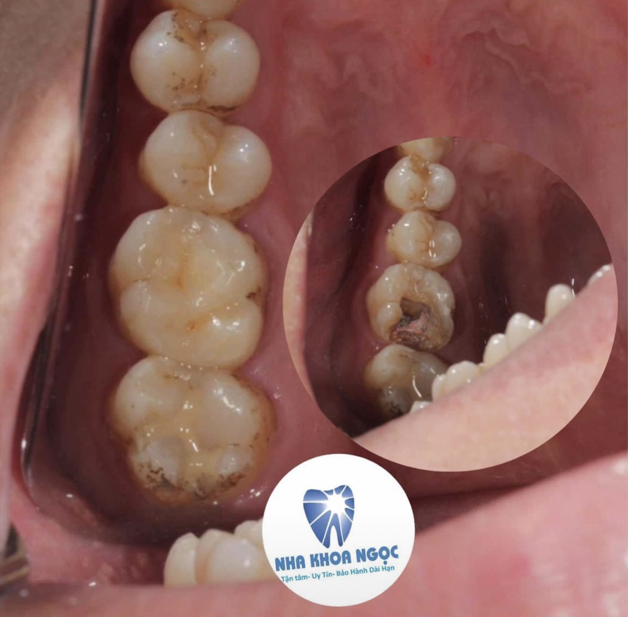 Đến với Nha khoa Ngọc sử dụng phương pháp hàn răng sứ inlay onlay Thái Bình góp phần đẩy lùi tình trạng sâu răng