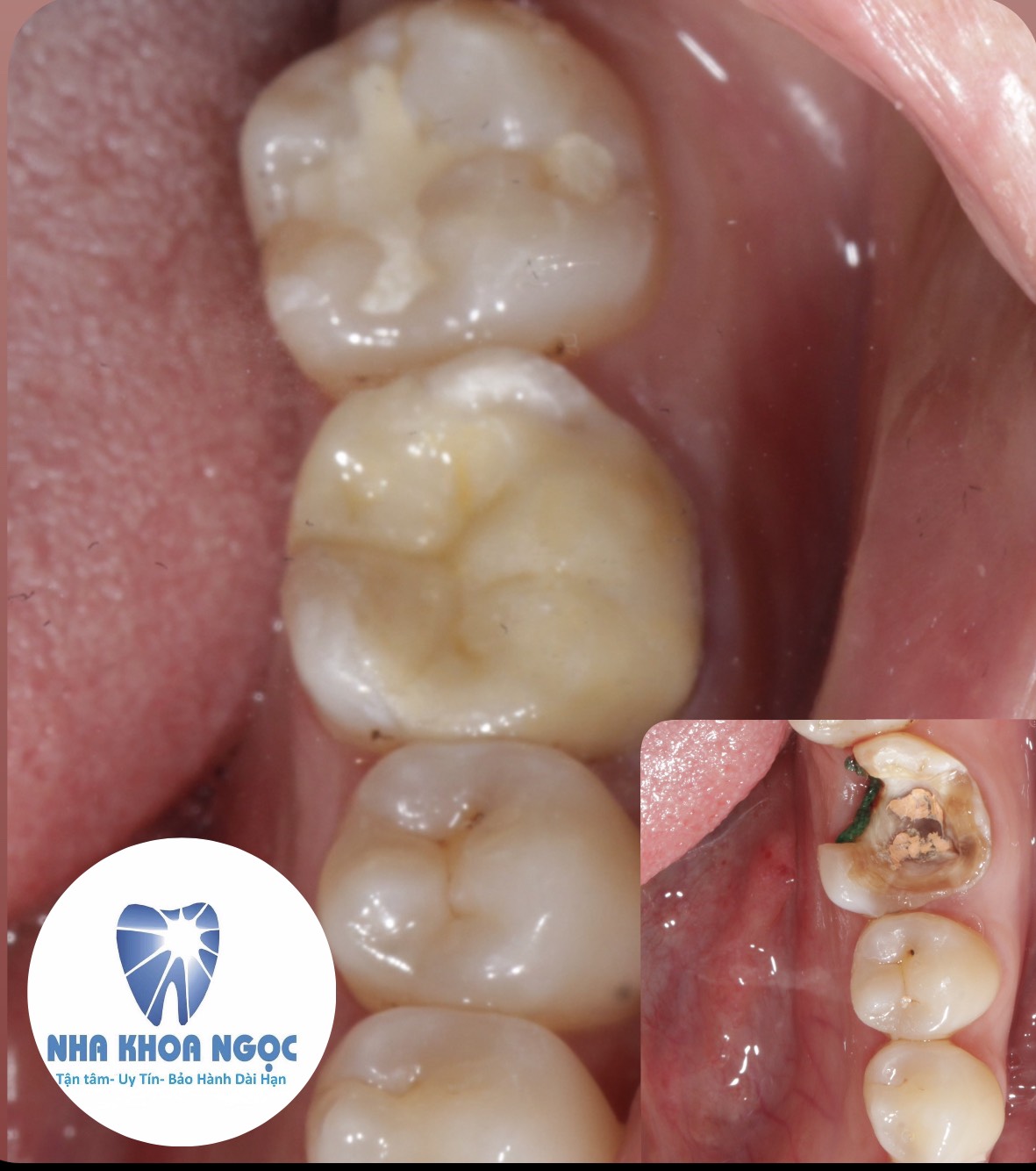 Hàn răng sứ inlay onlay Thái Bình trường hợp cần phục hình 4 Địa chỉ hàn răng sứ inlay onlay ở Thái Bình uy tín có chuyên môn cao