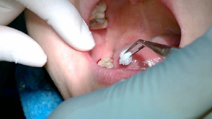 Quá trình nhổ răng khôn tại Nha Khoa Thái Bình