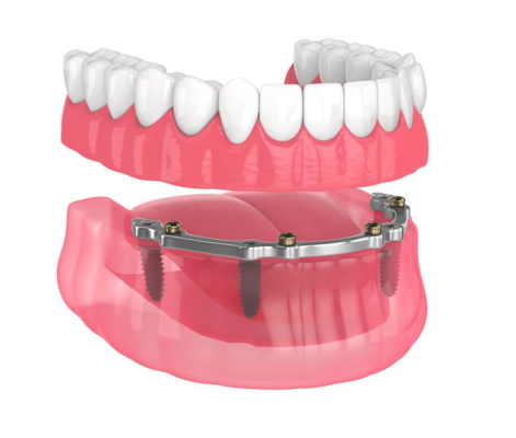 Ưu điểm của trồng răng implant all on 4 tại Thái Bình