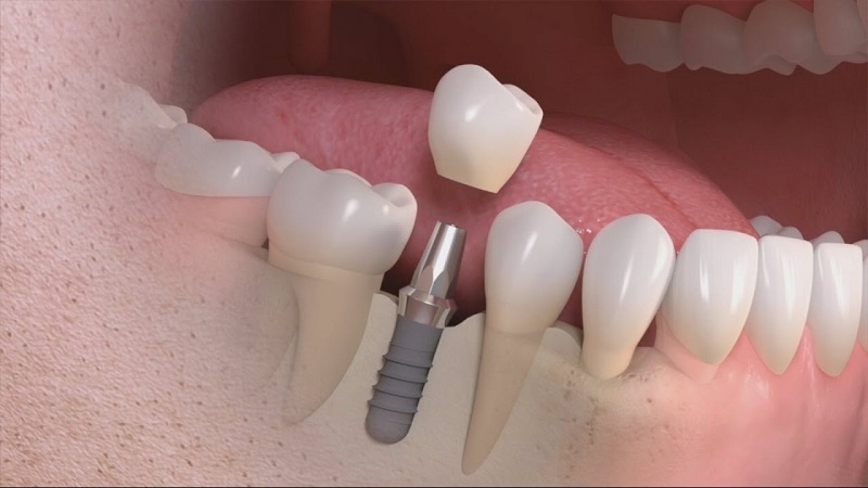 Trồng răng implant Thái Bình mất bao lâu và kế hoạch điều trị