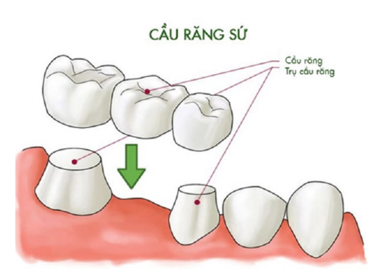 Các phương pháp trồng răng cố định ở Thái Bình