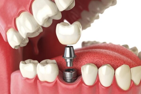 Trồng răng implant tại Thái Bình với mục đích thay thế cho những chiếc răng đã mất.