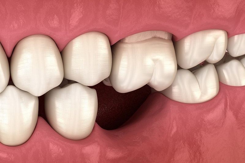 Trồng răng implant tại TP Thái Bình cho xương hàm bị tiêu nhiều