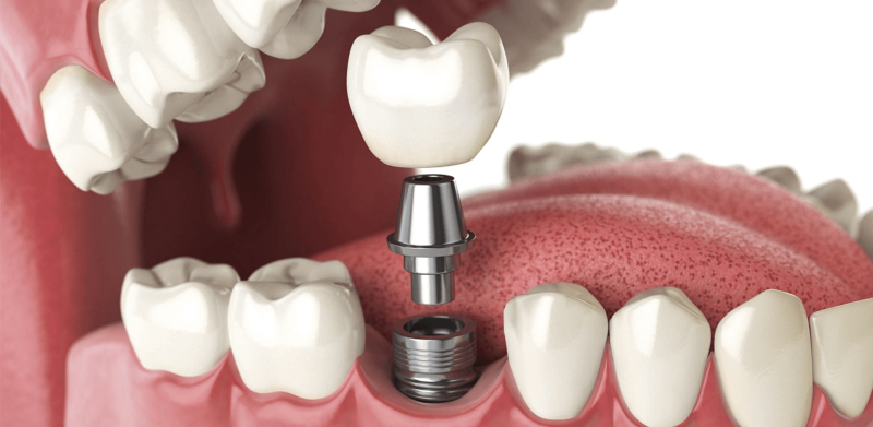 Trồng răng số 6 như thế nào? Quy trình cấy ghép implant răng 6