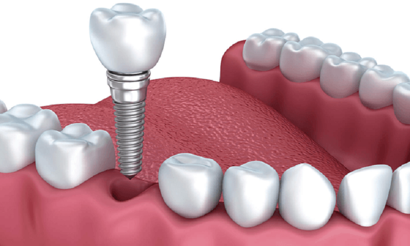 Trồng răng implant Thái Bình là gì? đối tượng nên trồng răng Implant