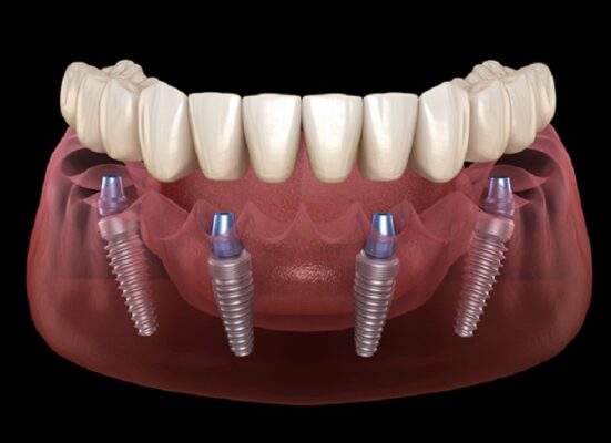 Cấy ghép implant được coi là một phát minh trong ngành nha khoa, là phương pháp phục hồi lại chân răng đã mất