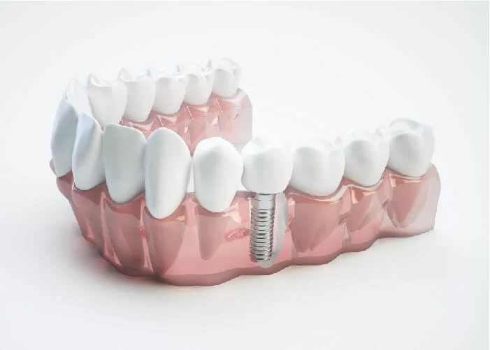 Địa chỉ trồng răng implant Thái Bình uy tín chất lượng nhất