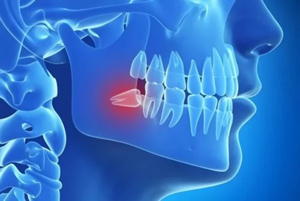 Những điều cần lưu ý sau khi nhổ răng số 8 - nhổ răng khôn tại Thái Bình