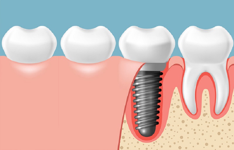 Trồng implant răng hàm tại Thái Bình - những nguyên nhân gây mất răng hàm