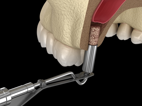 Trồng răng implant Thái Bình mất bao lâu và kế hoạch điều trị