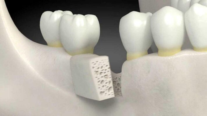 Nâng xoang trong cấy ghép implant khi nào?