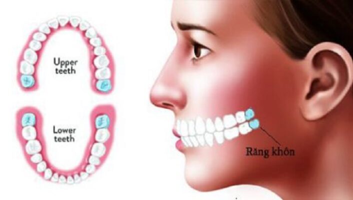 Những điều cần lưu ý sau khi nhổ răng số 8 - nhổ răng khôn tại Thái Bình