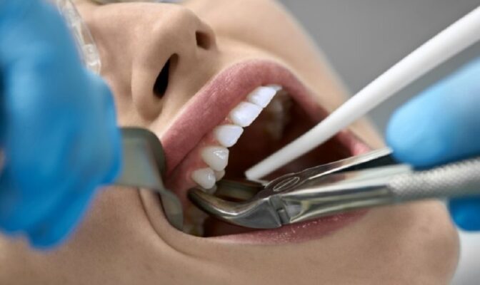 Có nên nhổ răng khôn tại Thái Bình không,quy trình nhổ răng khôn chuẩn nha khoa