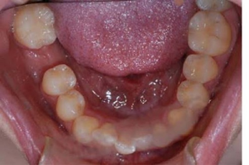 Trồng răng số 6 tại TP Thái Bình như thế nào? Quy trình cấy ghép implant