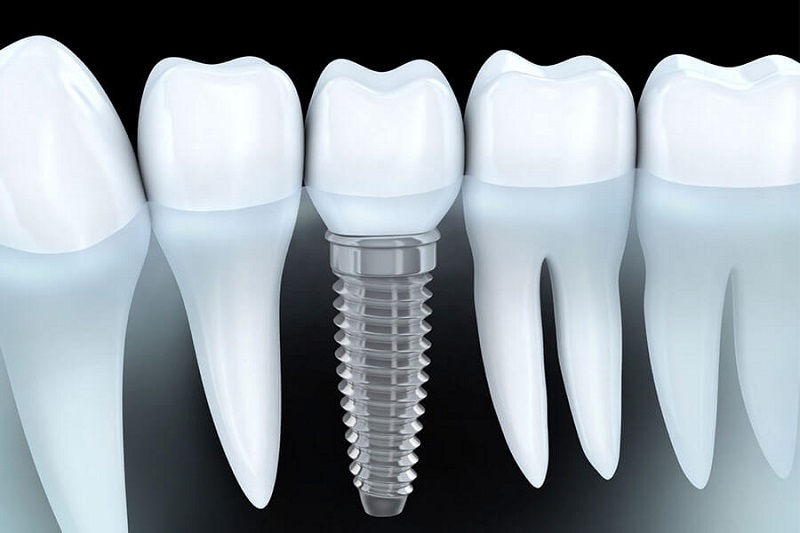Trồng răng implant Thái Bình công nghệ mới không đau an toàn