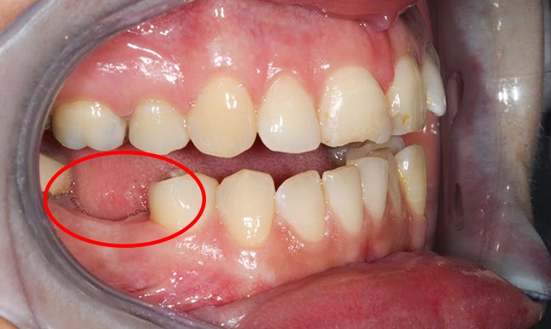Hậu quả của mất răng số 6 - Trồng răng số 6 tại TP Thái Bình