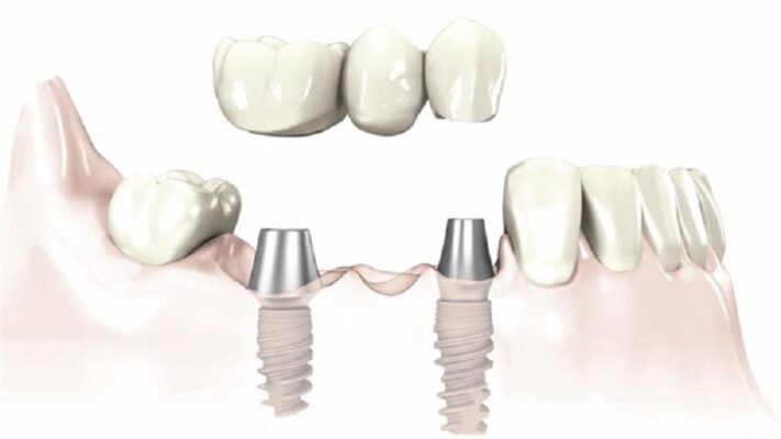 Quy trình cấy ghép chân răng implant tại Thái Bình uy tín chất lượng