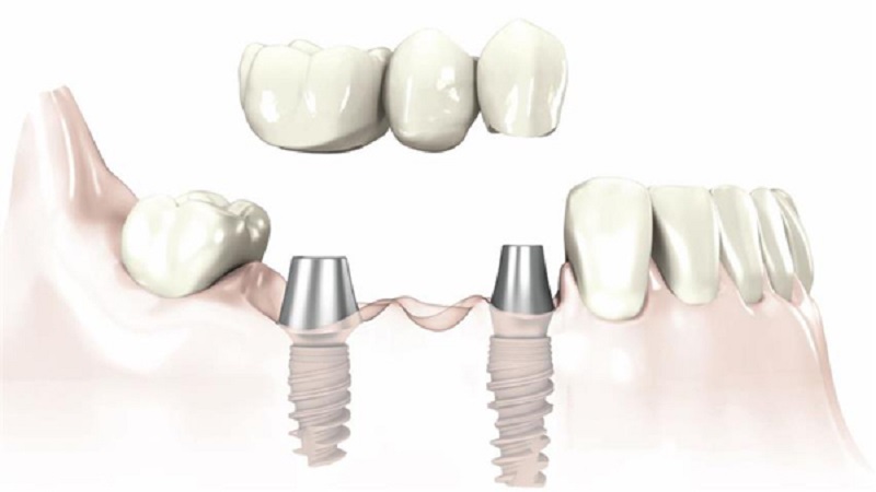 Trồng răng hàm Thái Bình là phương pháp phục hình răng đầu tiên hiện nay