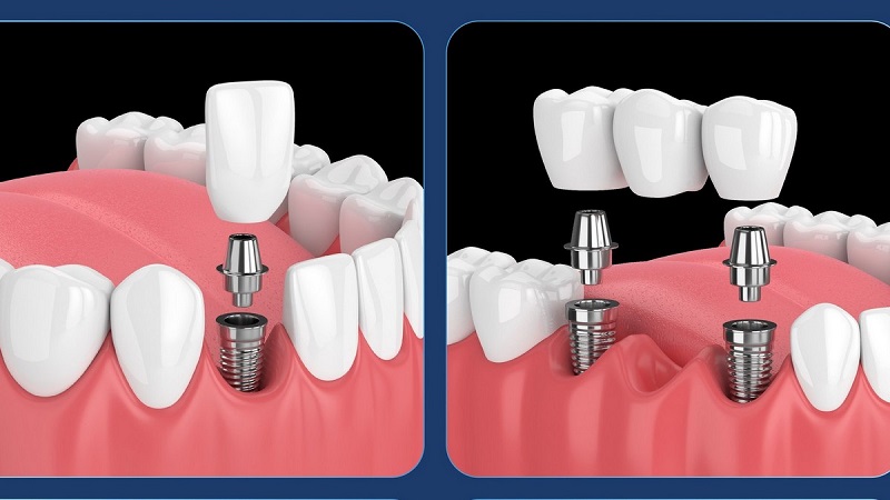 Trồng răng implant Thái Bình giá đắt hay rẻ