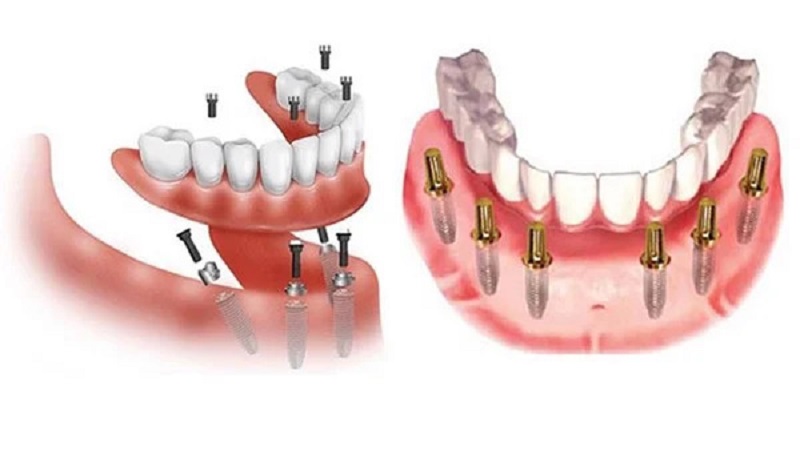 Trồng răng implant Thái Bình công nghệ mới không đau an toàn