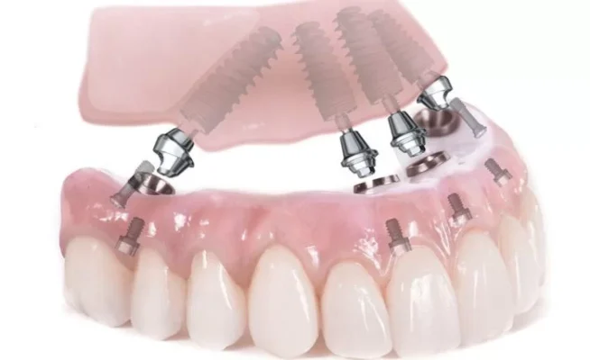 Trồng implant răng hàm như thế nào ?