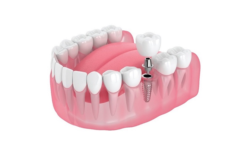 Trồng răng implant Thái Bình có ưu điểm gì?