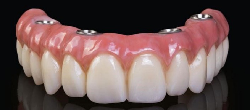 Trồng răng implant toàn hàm tại Thái Bình uy tín nhất