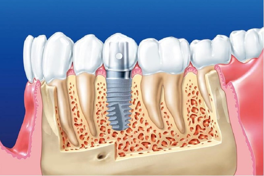 Nguyên nhân răng hàm bị sâu và phương pháp trồng răng hàm Thái Bình