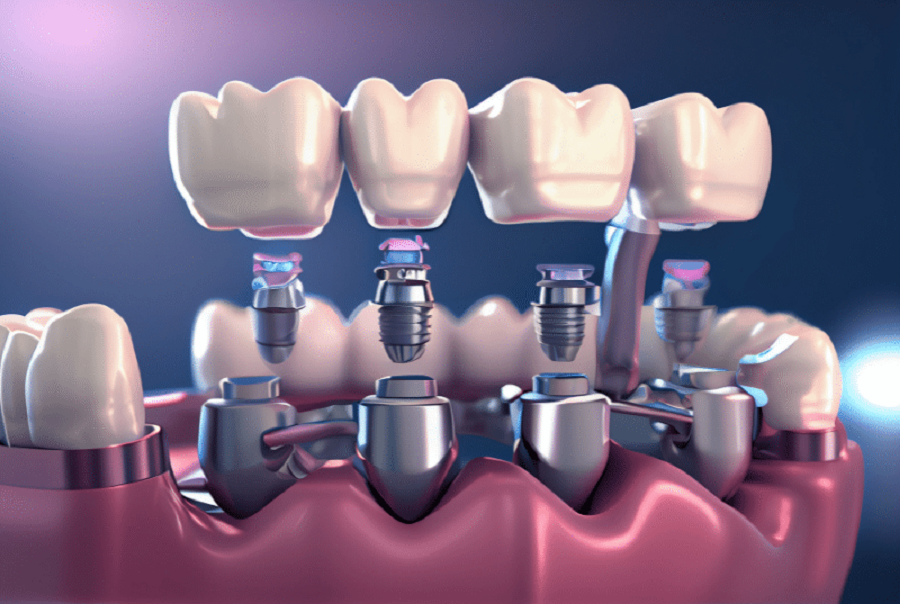 Ưu điểm trồng răng implant Thái Bình và cách chăm sóc