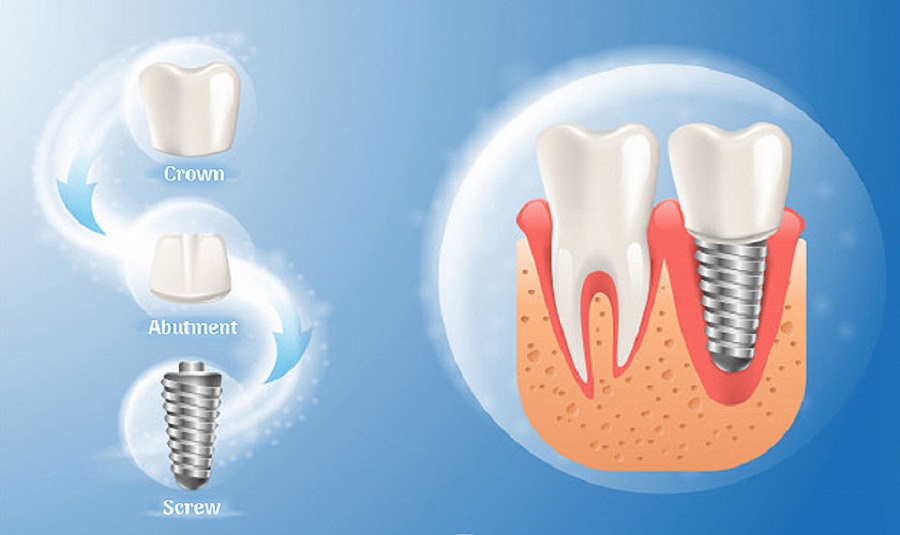 Ưu điểm của công nghệ trồng răng implant Thái Bình