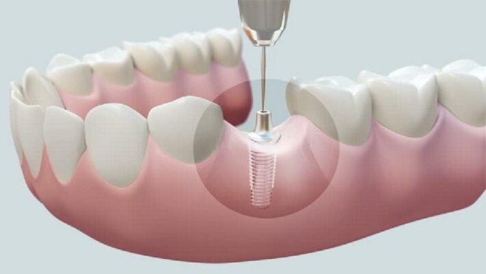 Trung tâm nha khoa uy tín chuyên trồng răng hàm Thái BTrồng răng implant tại Thái Bình uy tín chất lượng bạn nên chọnình